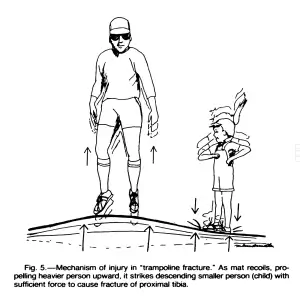 Trampoline Fracture